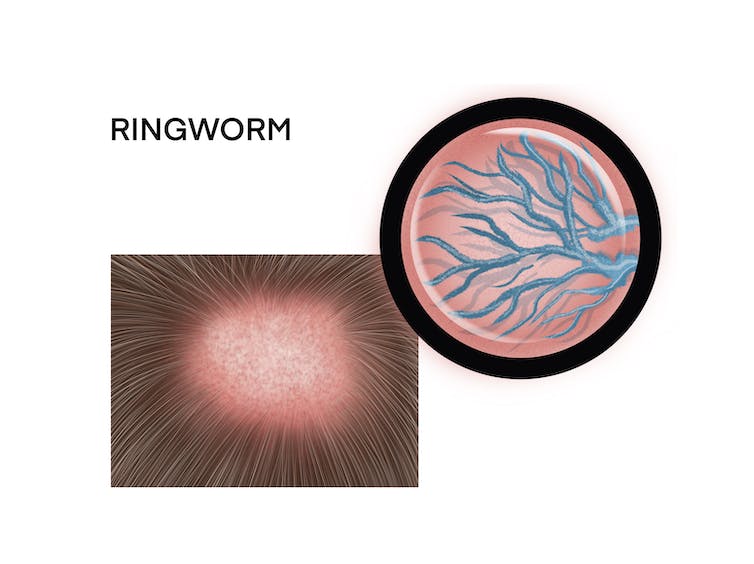 Ringworm fungal infections are common in the US and are becoming increasingly resistant to treatment – 6 questions answered