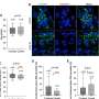 Short telomeres in alveolar type II cells associate with lung fibrosis in post COVID-19 patients with cancer