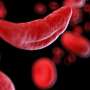 Sickle cell raises COVID-19 risk, but vaccination lags: Study