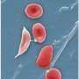 Sickle cell and COVID-19: A risky mix of two diseases