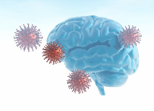 Mounting research shows that COVID-19 leaves its mark on the brain, including with significant drops in IQ scores