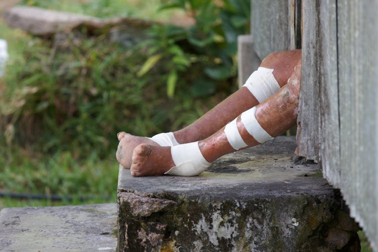 Leprosy cases are rising in the US – what is the ancient disease and why is it spreading now?