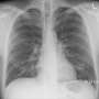 Severe lung infection during COVID-19 can cause damage to the heart