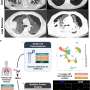 Simple blood test could predict risk of long-term COVID-19 lung problems