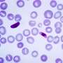 Synthetic compound shows promise against drug-sensitive, drug-resistant strains of human malaria parasites