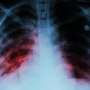 Once again, tuberculosis becomes world’s top infectious disease killer