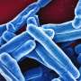 ‘Unprecedented’ tuberculosis outbreak is underway in Kansas: Are Californians at risk?