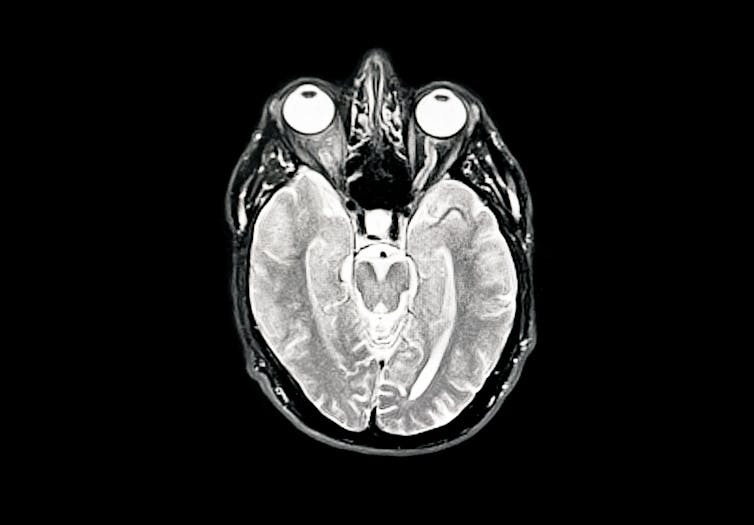 Vaccines hold tantalizing promise in the fight against dementia