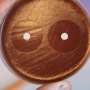 Gonorrhea cases rise as antibiotic resistance limits treatment options