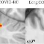 COVID-19 leaves a lasting mark on the human brain, MRI techniques reveal