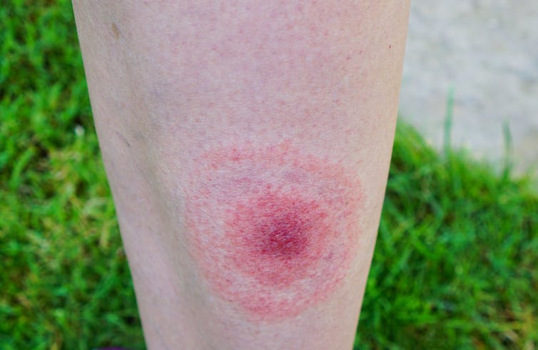 Ticks are the backyard threat southwestern Pennsylvania homeowners keep ignoring