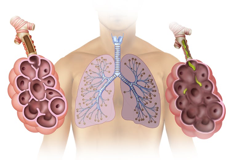 More than 140,000 Americans die from COPD each year – here’s why survival depends on more than avoiding smoking