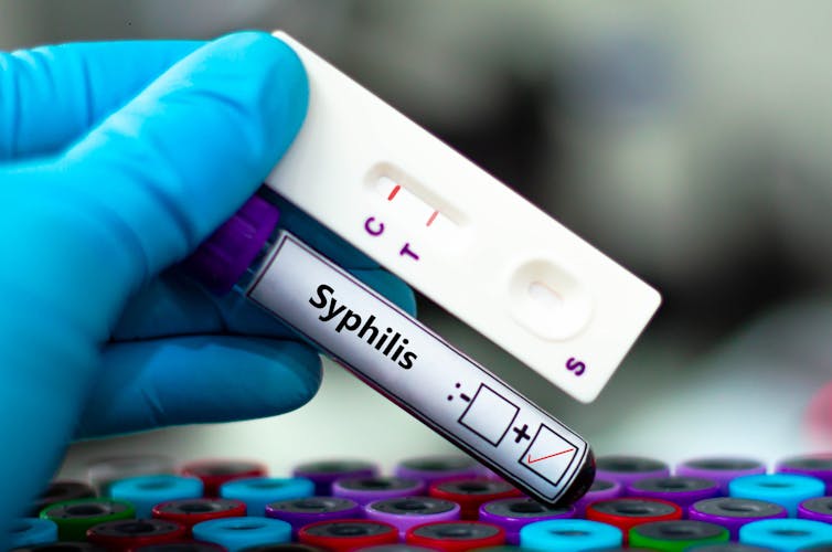 Syphilis cases in expectant mothers have dramatically risen since the pandemic – here’s what’s driving the trend