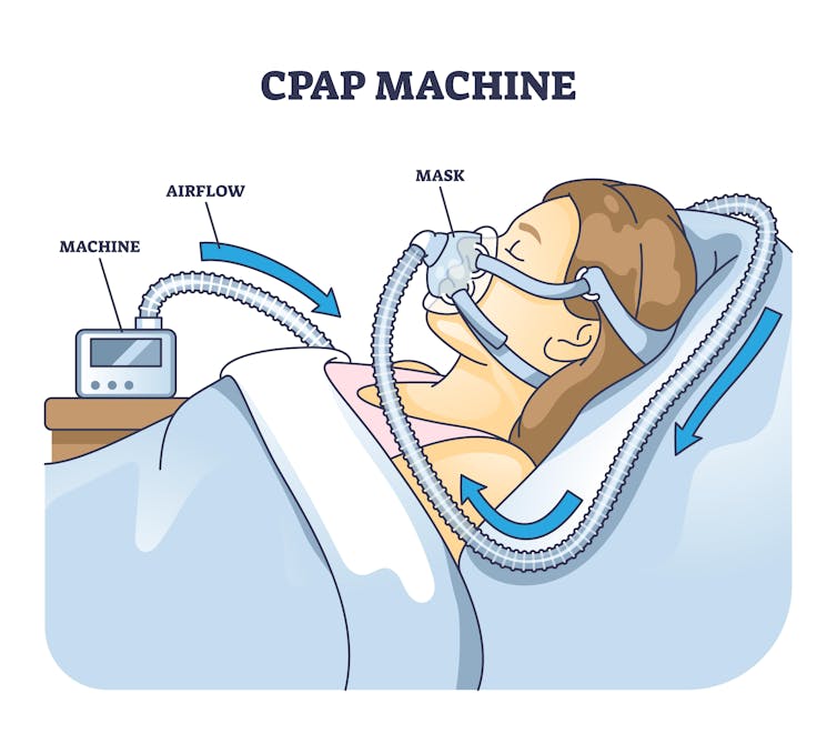 Sleep apnea compromises far more than a good night’s rest – 2 neuroscientists outline the risks and the need for better diagnosis